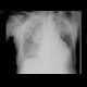 Lung oedema: X-ray - Plain radiograph